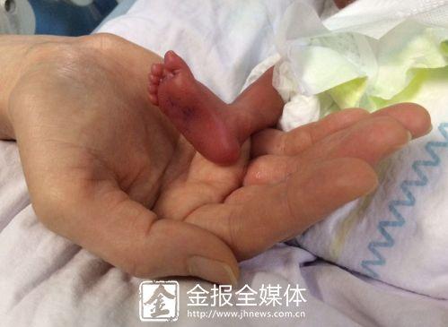 仅25周 金华最小超早早产儿创下康复奇迹