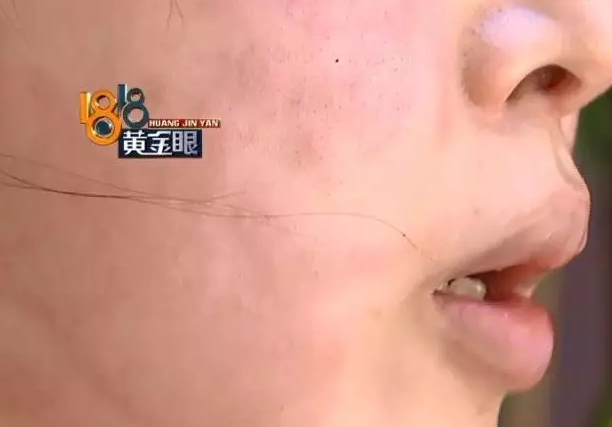 杭州一美女美容后脸红肿 带刀去找院长